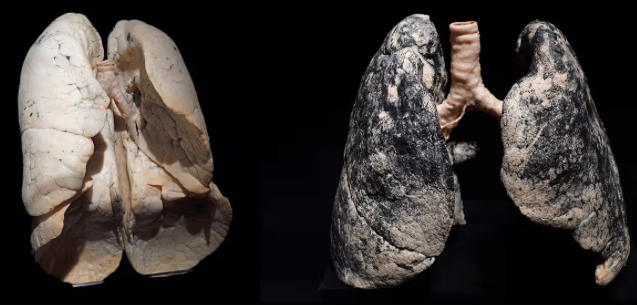 Healthy lungs on left, smokers lungs on the right. Marijuana leaves four times the amount of tar in your lungs than tobacco does (Alamy Stock Photo)
